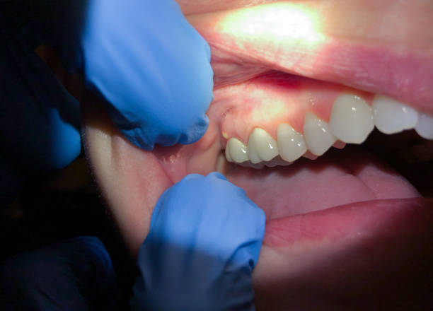 Best Emergency Dental Services for Seniors in Cherry Grove, OH